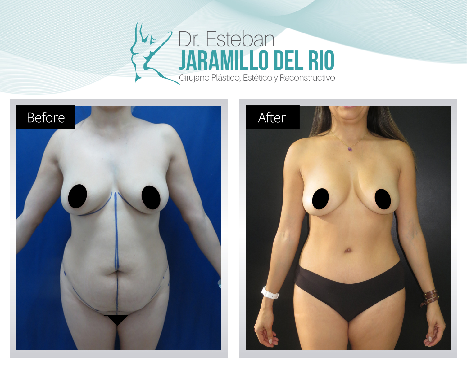 Lipoabdominoplastia Frente RE