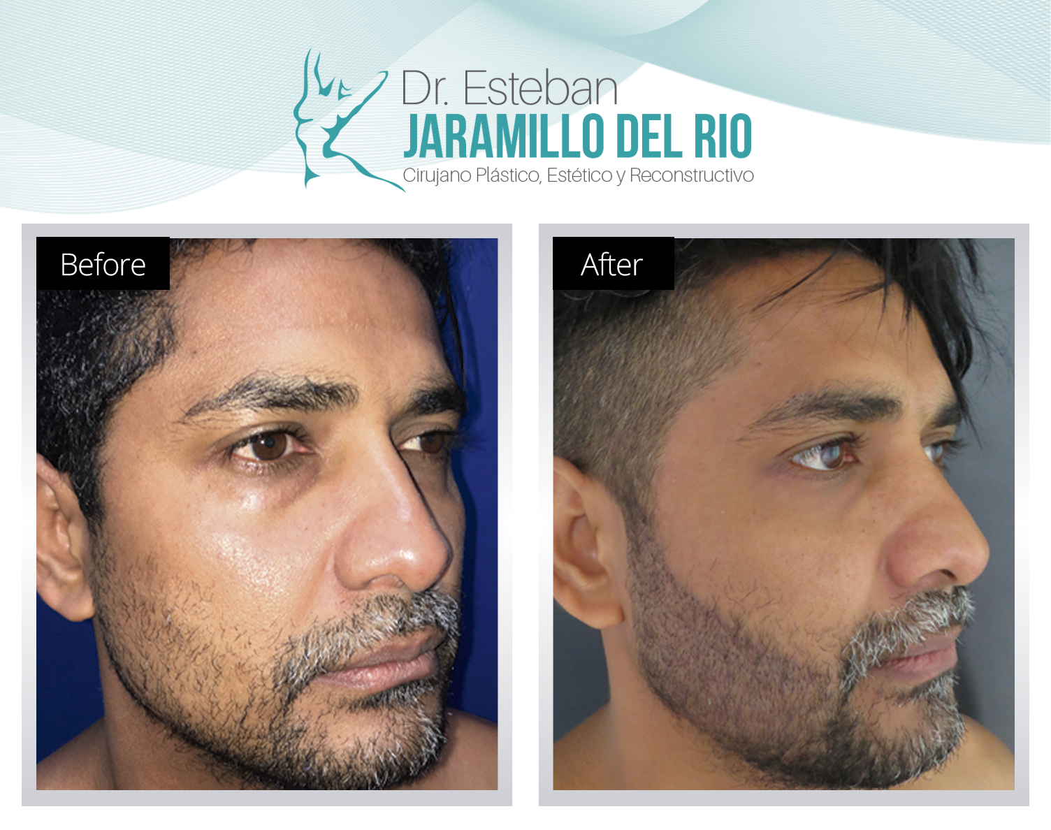 Blefaroplasty Colombia