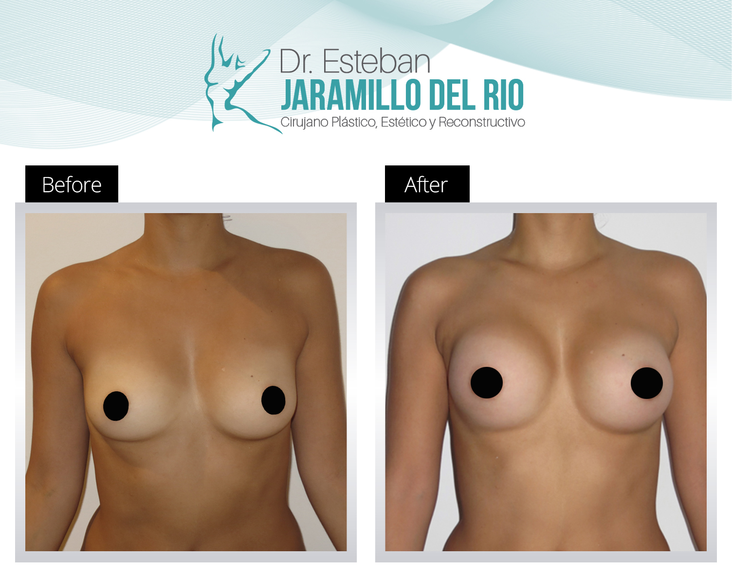 Breast augmentation in Colombia