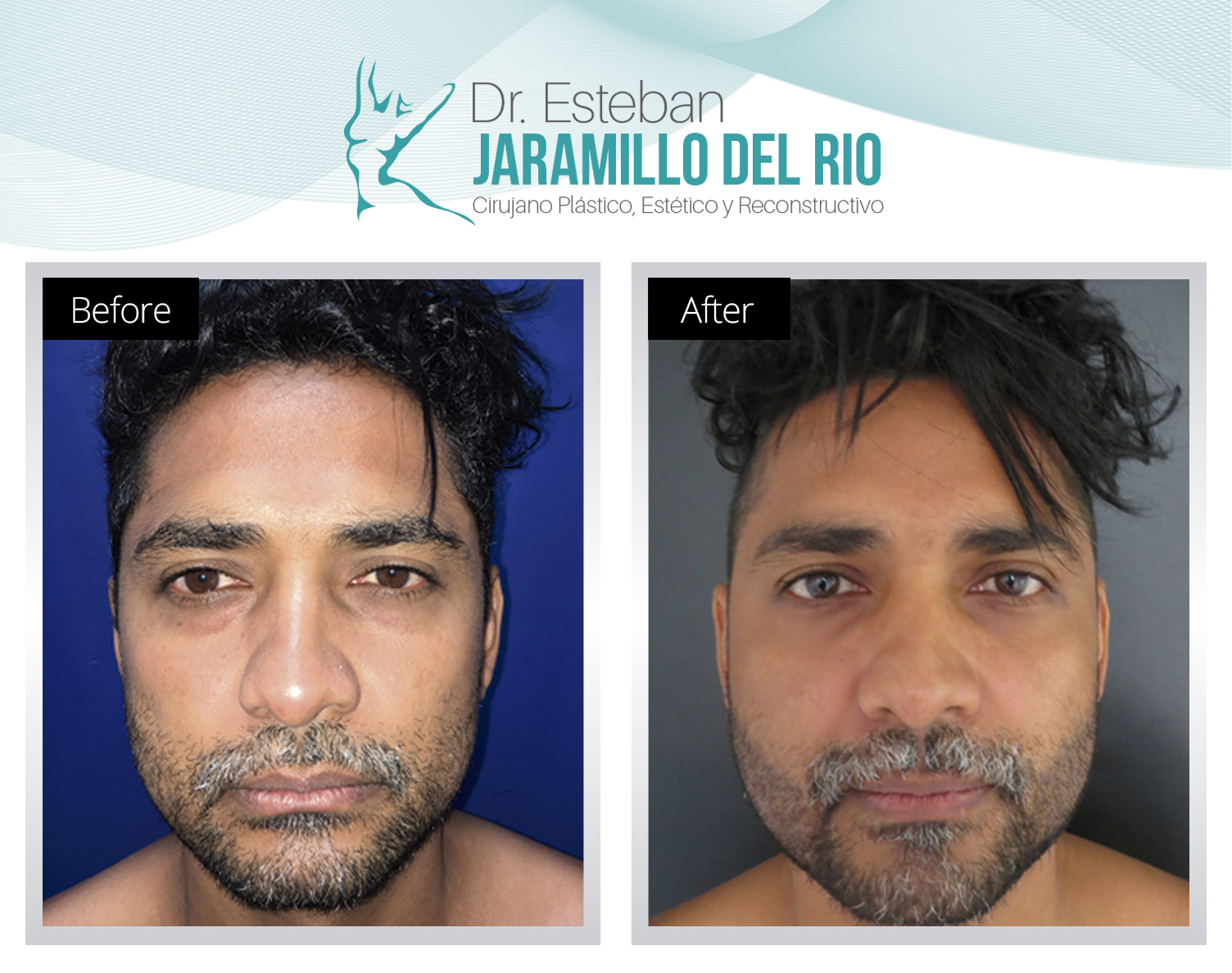 Eyelids surgery Colombia