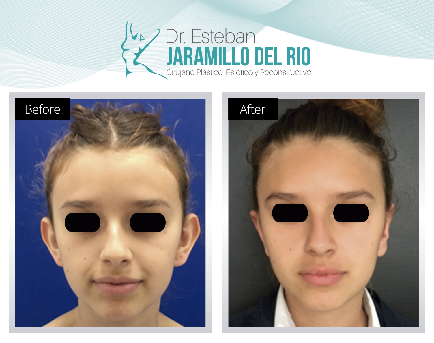 Otoplasty Colombia