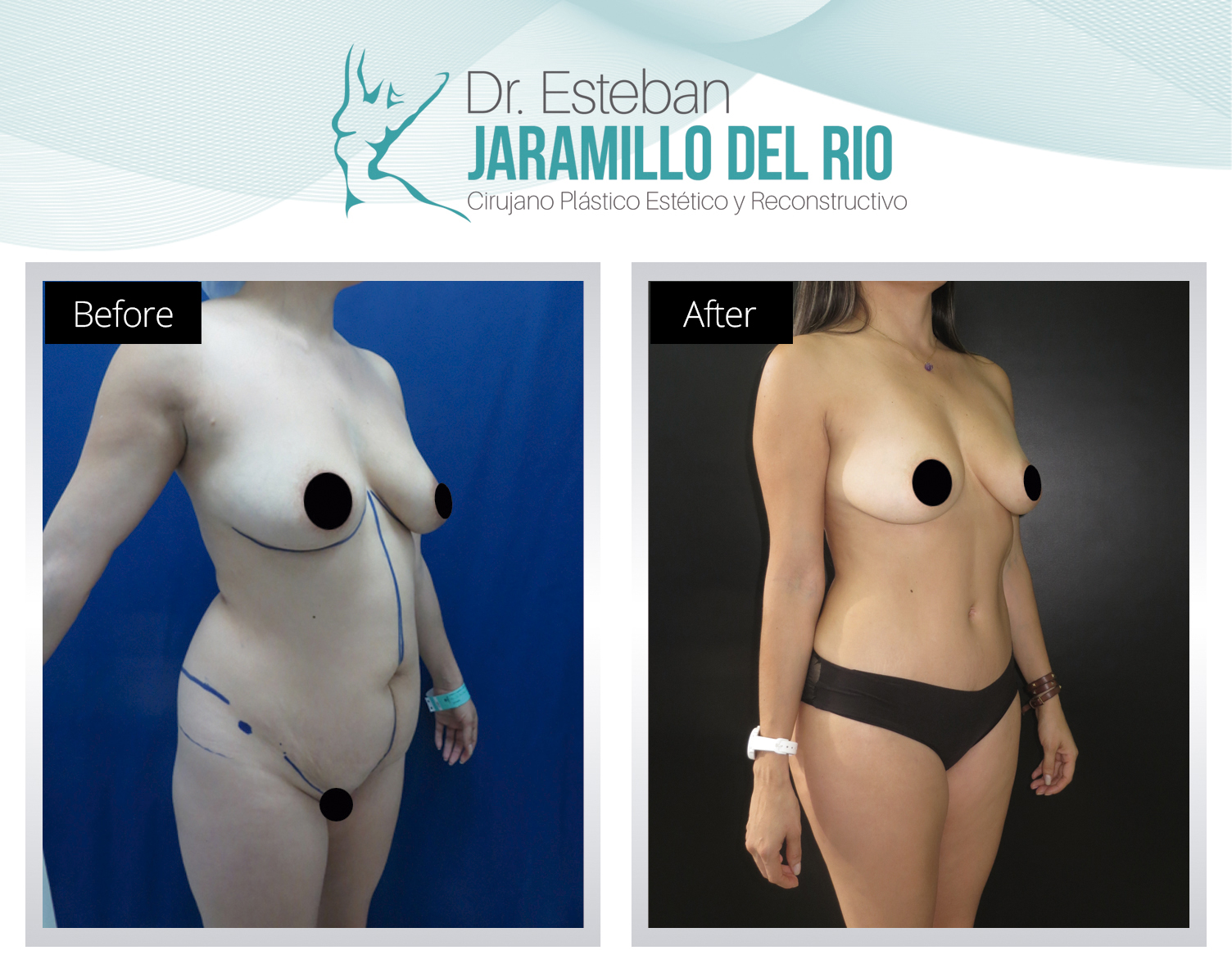 Tummy tuck surgery Colombia