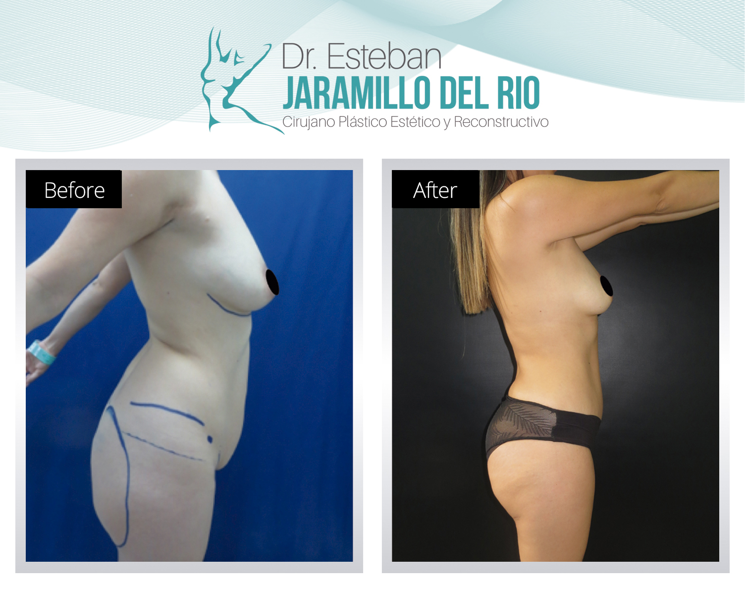 Tummy tuck surgery in Colombia